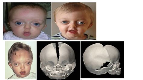 Pediatric Crouzon Syndrome .